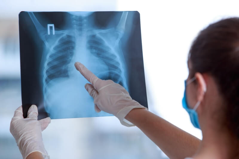 tuberculosis x-ray