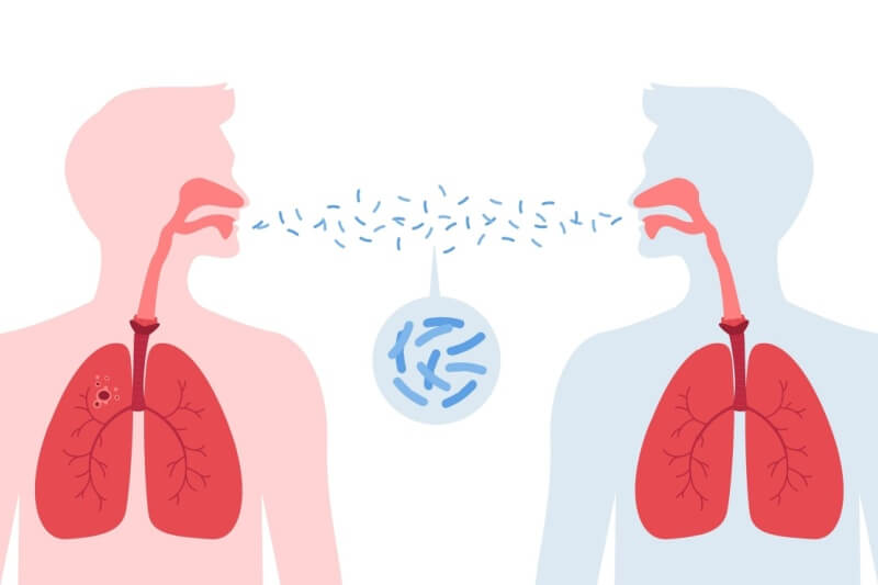 tuberculosis contagious