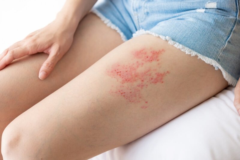 woman with shingles on leg