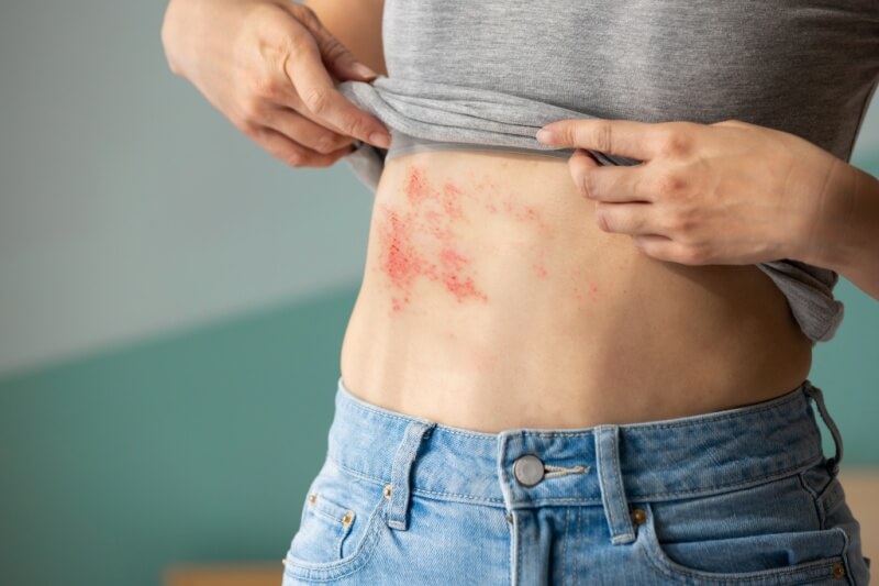 woman with shingles on abdomen