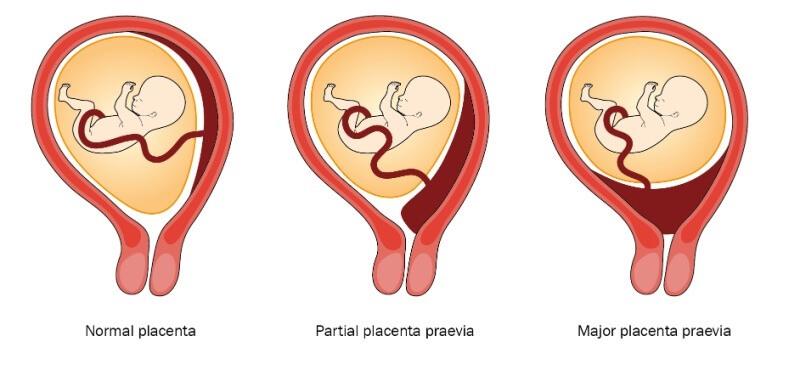 Placenta previa condition