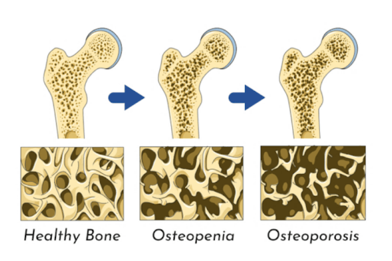 human bone structure with osteoporosis diagram