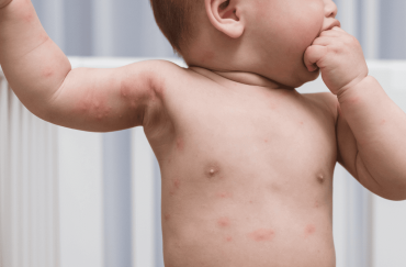 image of young infant with sensitive skin and itchy marks