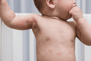 image of young infant with sensitive skin and itchy marks