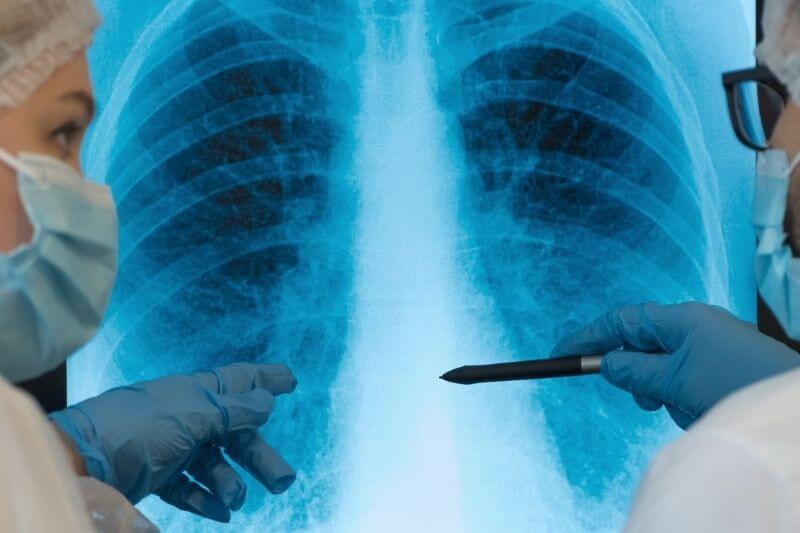 Close up of x-ray of patient with lung pneumonia caused by Coronavirus. Team of doctors at computer monitor in clinic discuss lungs are affected by virus. COVID-19