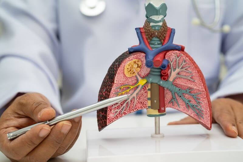 Pneumonia, lung cancer, Asian doctor holding human anatomy model for study diagnosis and treatment in hospital.