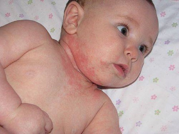 bayi alergi susu lactose intolerance