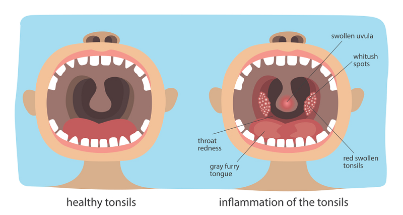Tonsilitis yang normal dan tidak normal