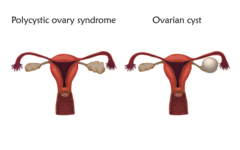 ovarian cyst VS pcos