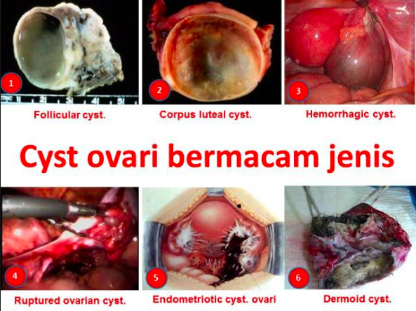 jenis jenis ovarian cyst