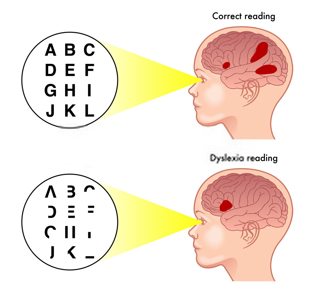 ciri-ciri disleksia