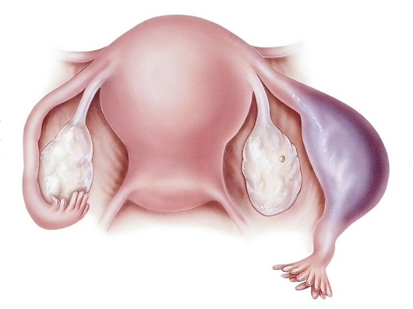 kehamilan luar rahim merupakan salah satu punca pendarahan ketika hamil