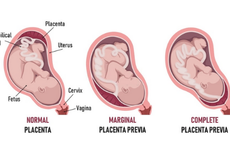placenta previa merupakan salah satu punca pendarahan ketika hamil