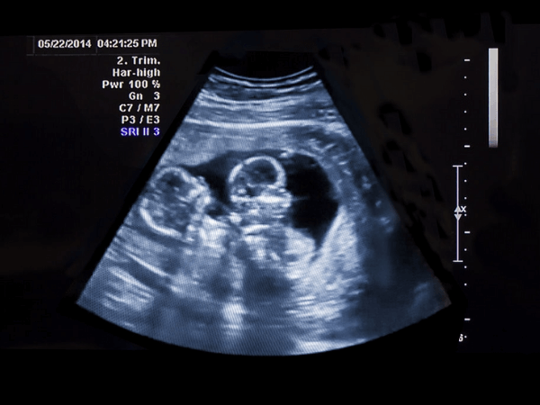 ultrasound kembar