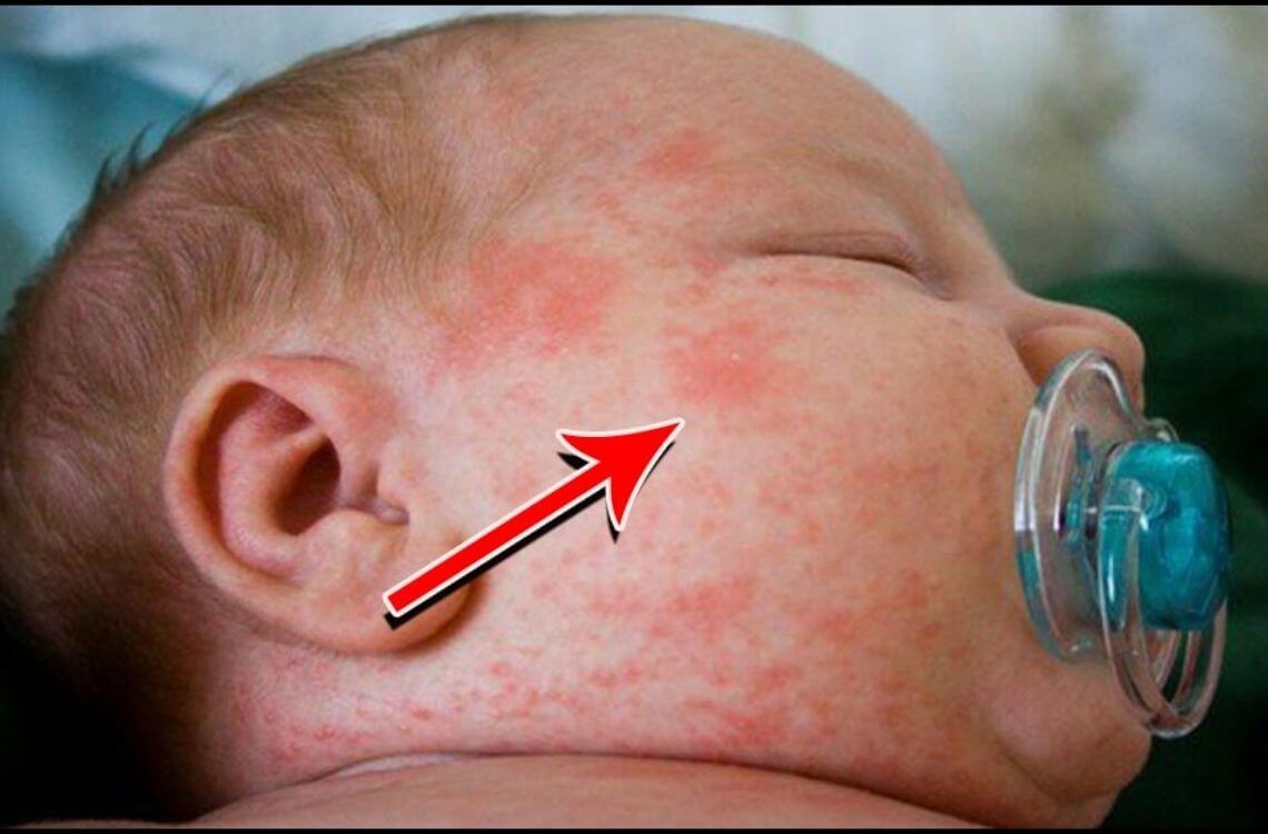 bayi alergik laktosa