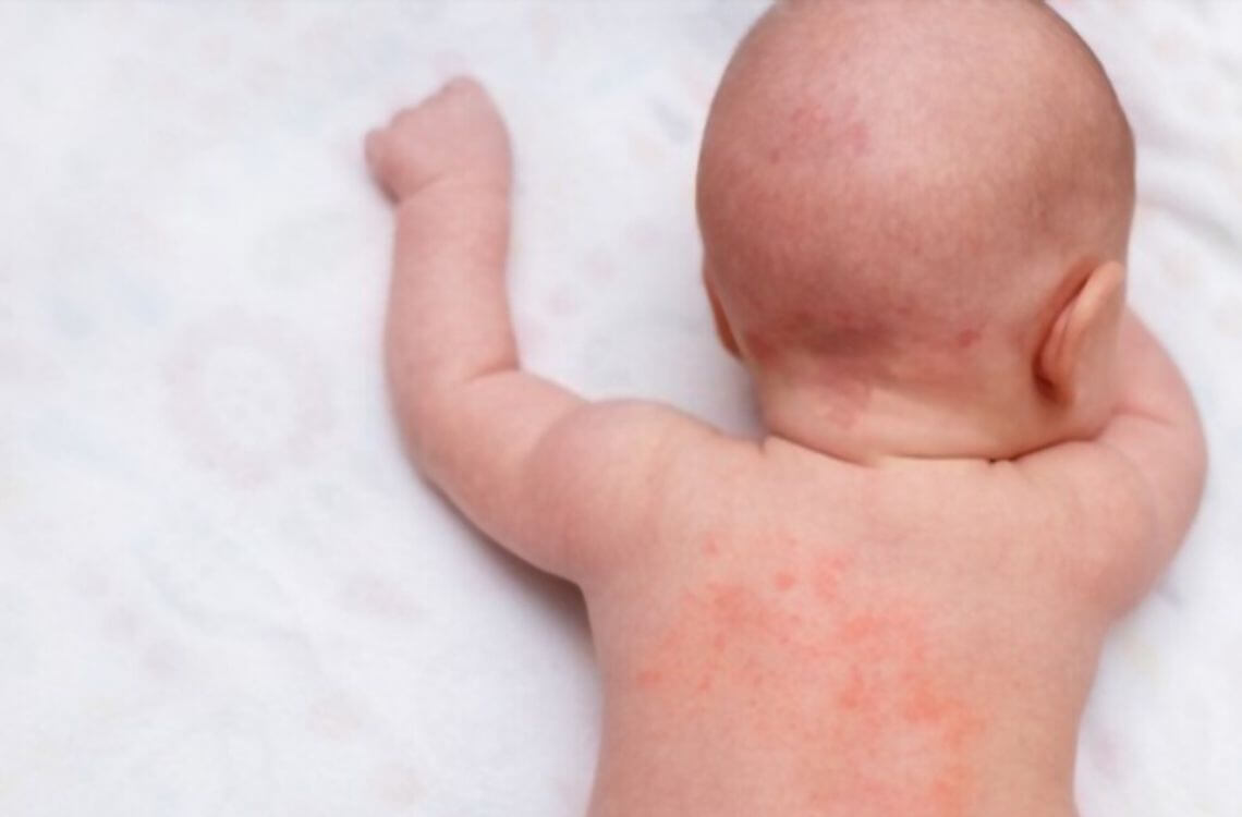 tanda-tanda suhu demam bayi yang tinggi dan membahayakan