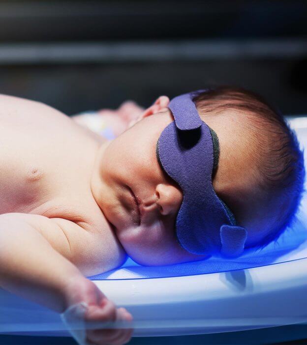 Fototerapi untuk merawat baby kuning