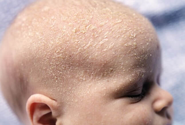 kerak kepala bayi juga merupakan antara jenis ruam bayi