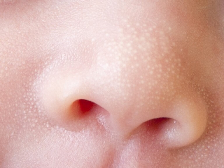 milia di hidung bayi merupakan antara jenis ruam bayi