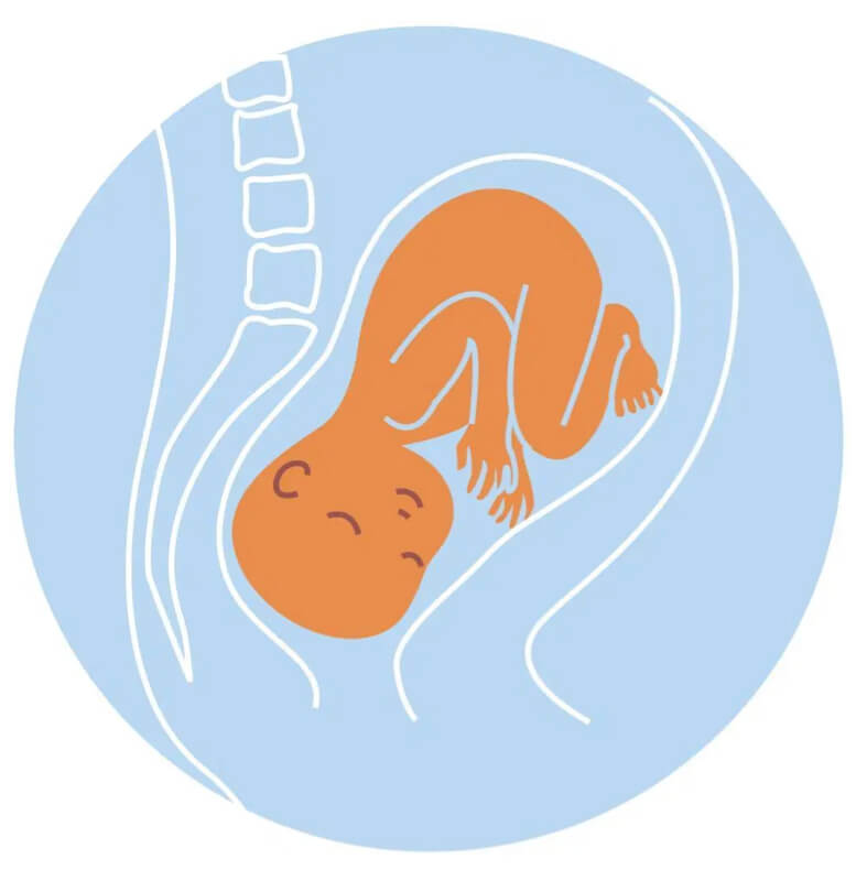 Kedudukan Bayi Dalam Kandungan - kedudukan posterior