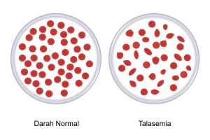darah normal vs darah talasemia