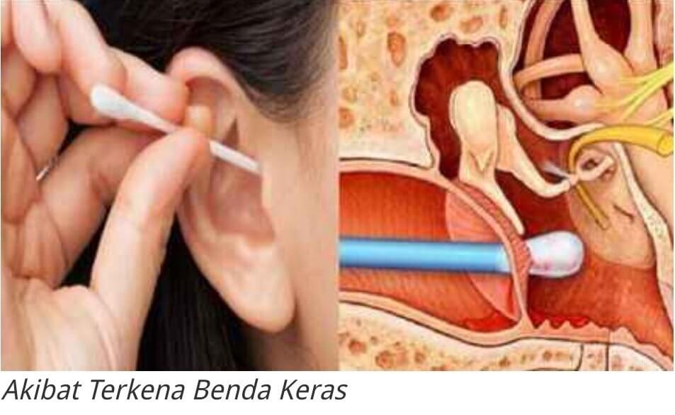 akibat korek telinga