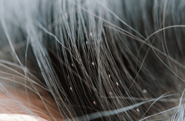 cara hilangkan kutu rambut