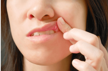 cara hilangkan ulser mulut