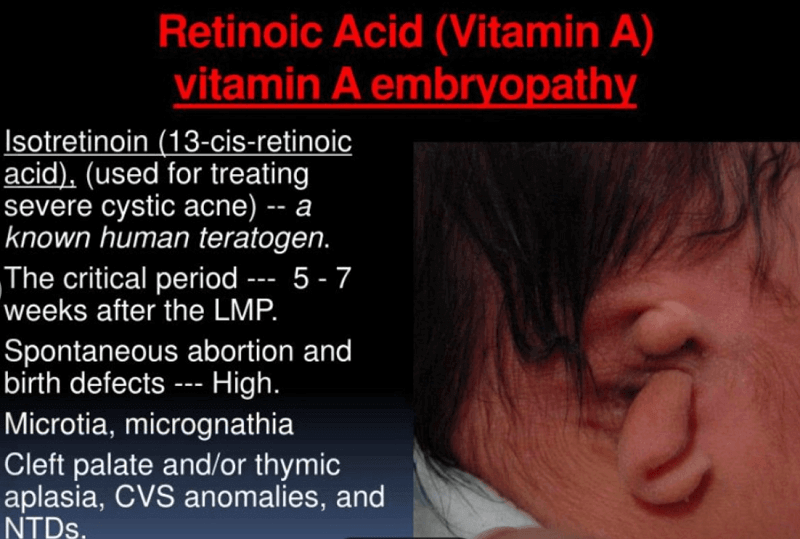 bahaya ubat jerawat, isotretinoin