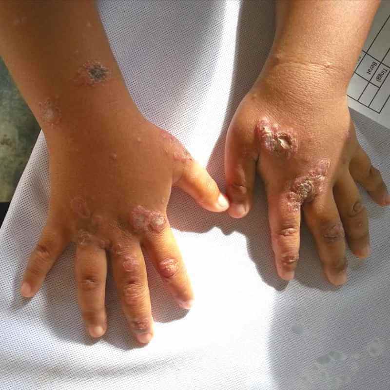 gambar kudis buta di kulit manusia