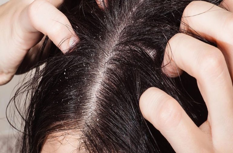 cara hilangkan kelemumur