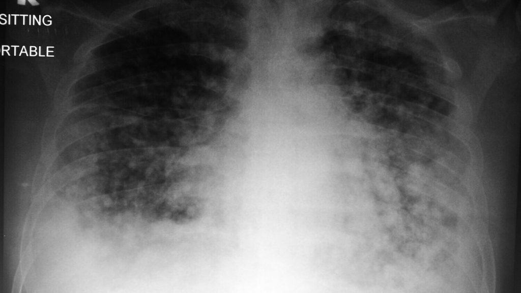 x-ray kanak-kanak yang nafas laju