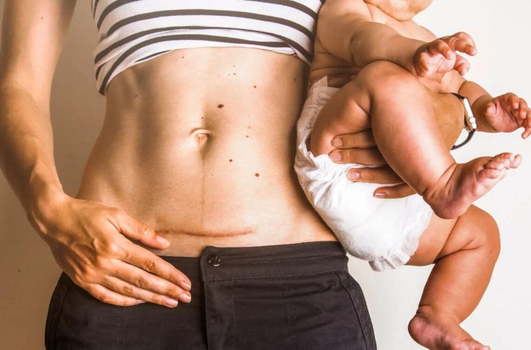 posisi tidur selepas bersalin secara pembedahan