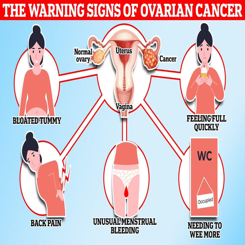 simptom kanser ovari