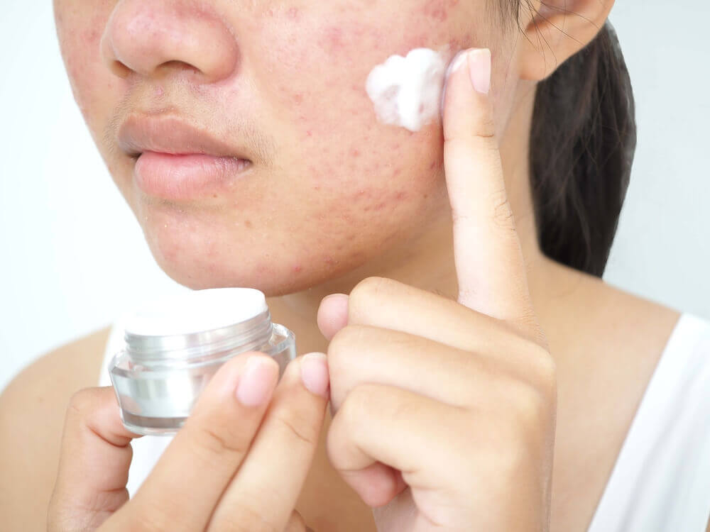 wanita menggunakan moisturizer sebagai cara hilangkan parut jerawat