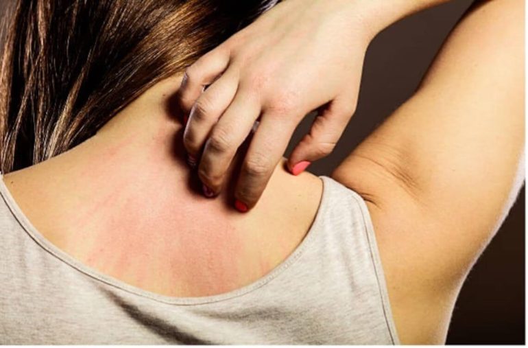 cara hilangkan gatal badan